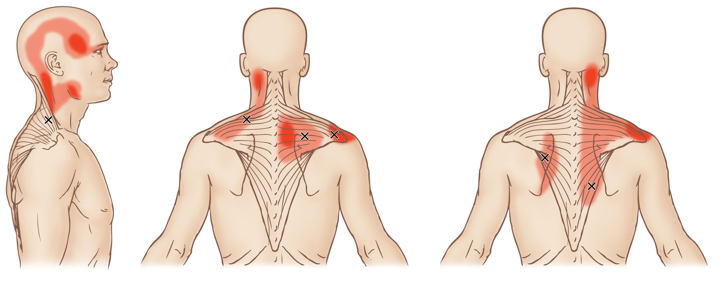 Fysiotherapie