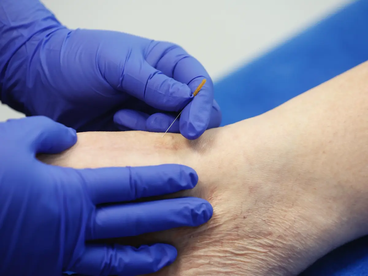 Dry needling Fysiotherapie NP